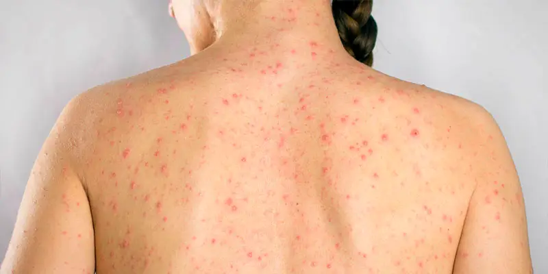 Las-autoridades-alertan-por-el-aumento-del-42-en-casos-de-sifilis